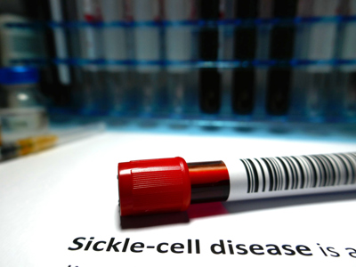 Sickle Cell Disease